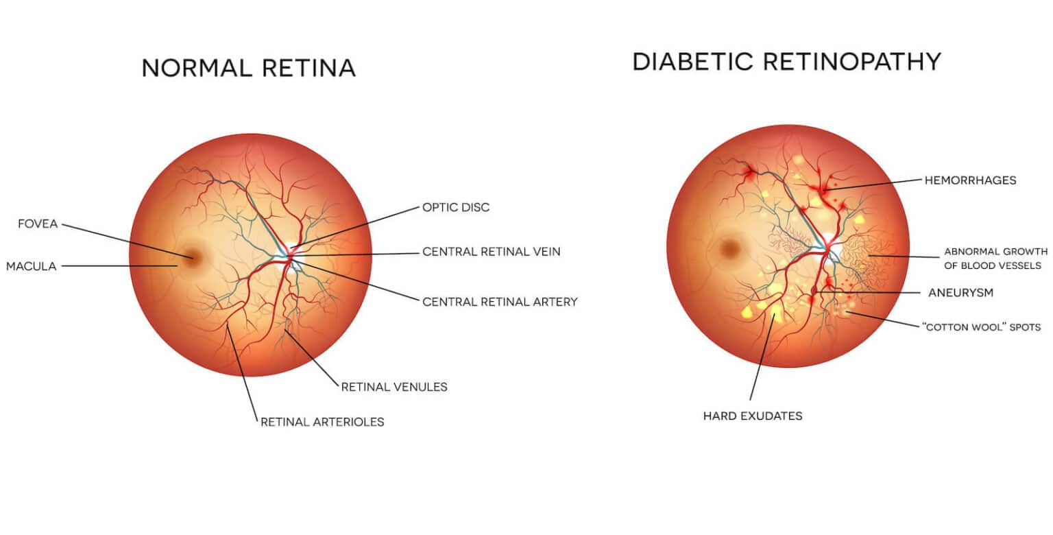 diagram of a normal eye vs an eye with diabetic retinopathy.