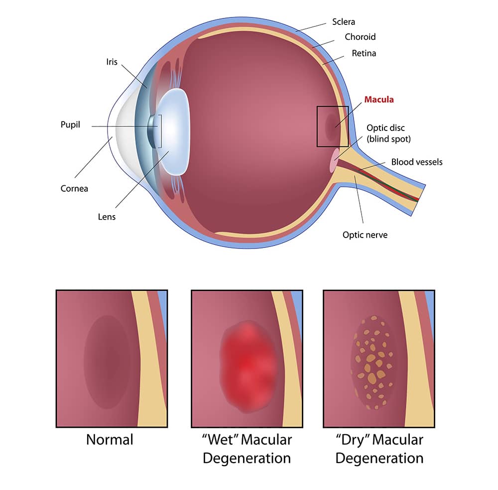 Diagram of wet vs dry macular degeneration.
